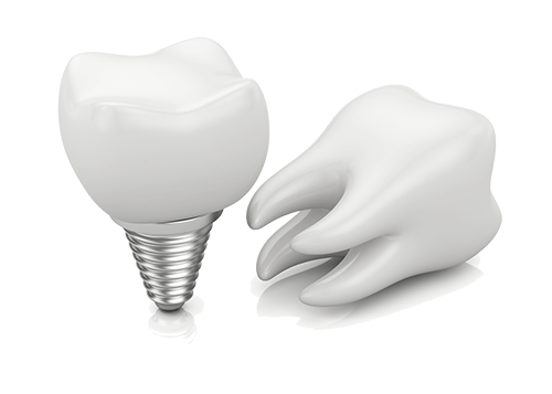 Dental Implants