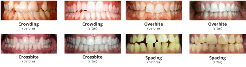 Invisalign Before & After Photos