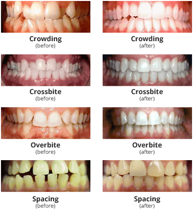 Invisalign: Before & After