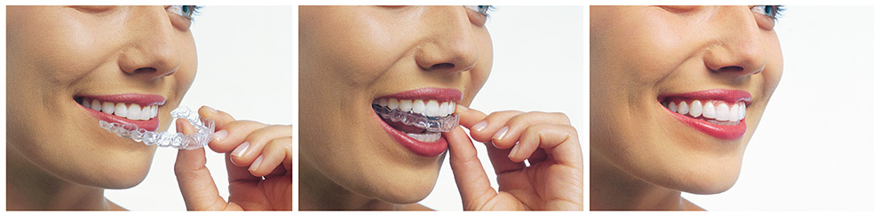 invisalign aligners clear orthodontics braces dental cosmetic cranbourne teeth cost lisp dentist dentistry nc much services mouth treatment clemmons aligner