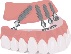 All-On-4 Teeth In a Day Illustration