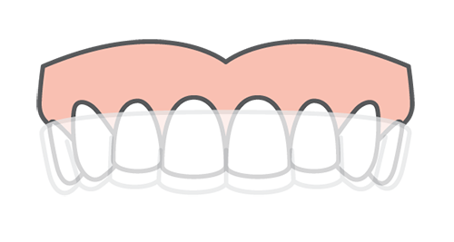 Clear Aligner