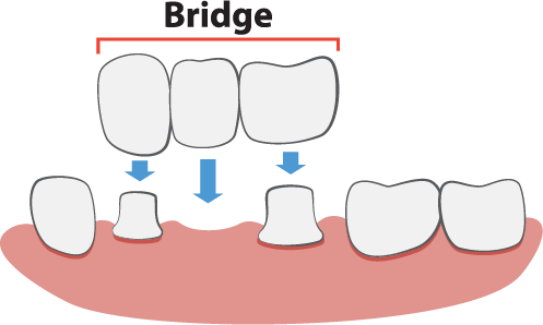 Dental Bridges Illustration