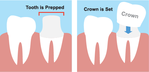 Dental Crowns Illustration