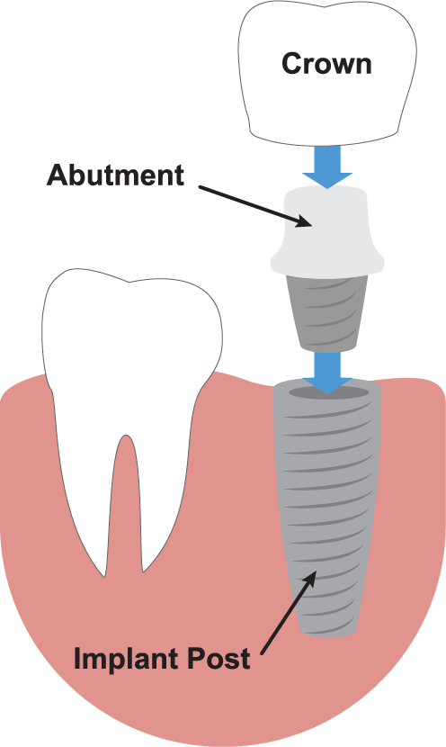 Dental Implants Illustration