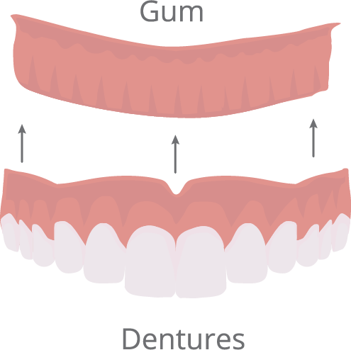 Dentures Illustration