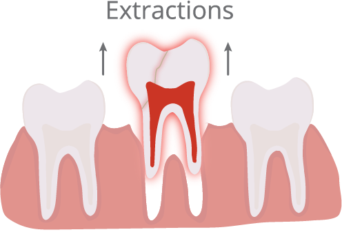 Extractions Illustration