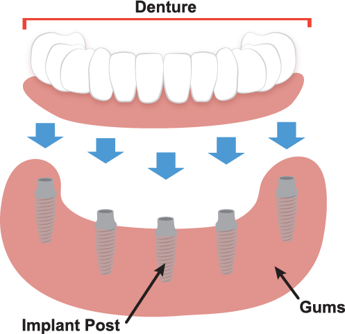 Implant Supported Dentures Illustration