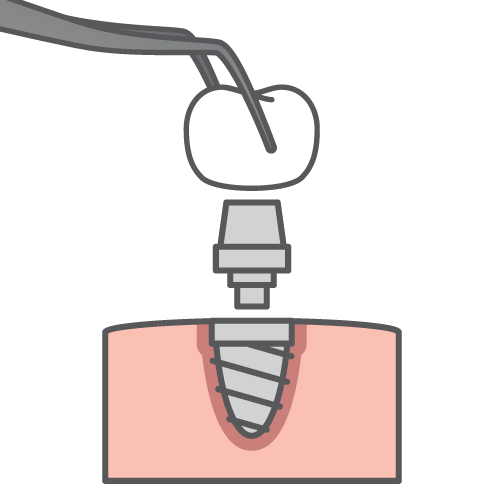 Dental Implants Illustration