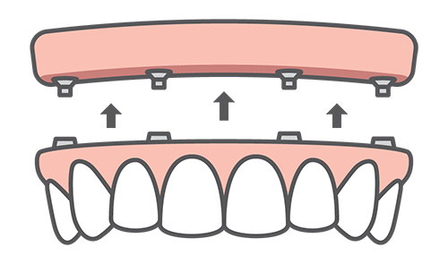 All-On-4 Teeth In a Day Illustration