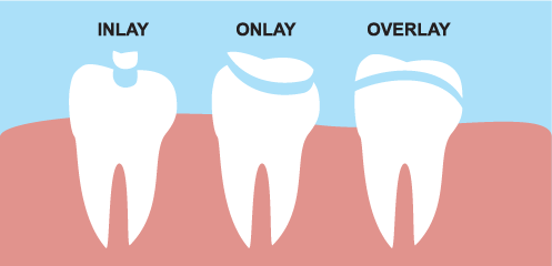 Inlay/Onlay/Overlay Illustration