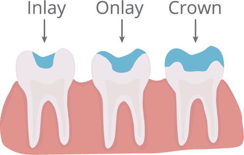 Inlays/Onlays Illustration