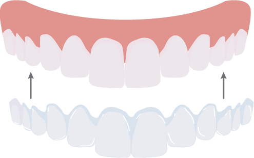 Invisalign