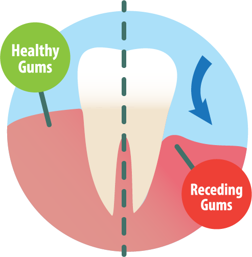 Receding Gums Illustration