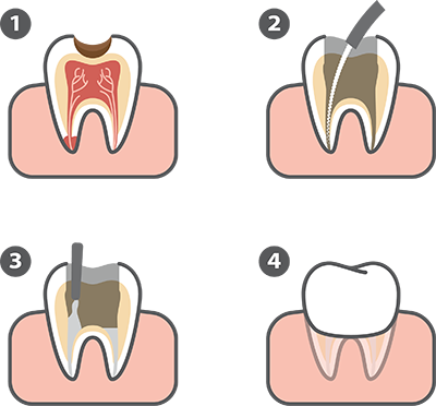 Root Canal Illustration