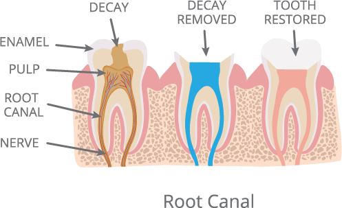 Root Canal Illustration