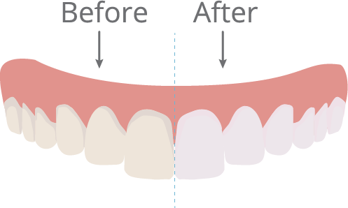 Teeth Whitening