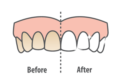 Teeth Whitening