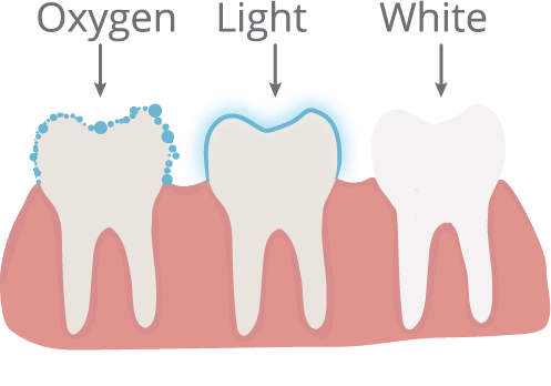 Teeth Whitening