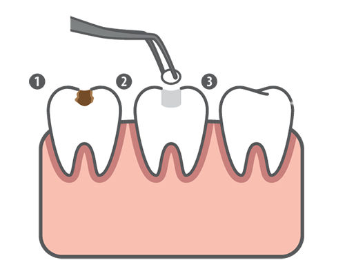 Tooth-Colored Fillings