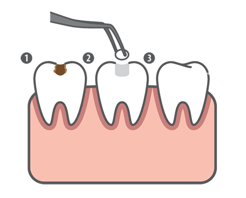 Tooth Filling, Stop Tooth Decay