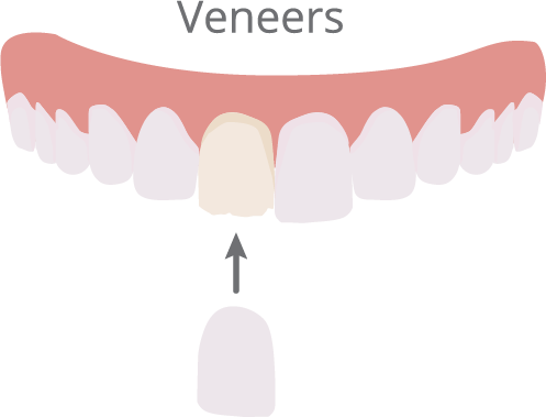 Veneers Illustration