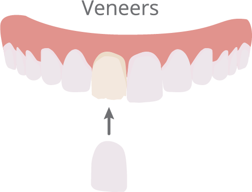 Cosmetic Dentistry for Worn Teeth