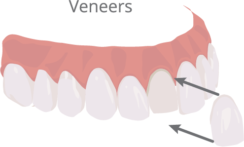 Veneers Illustration